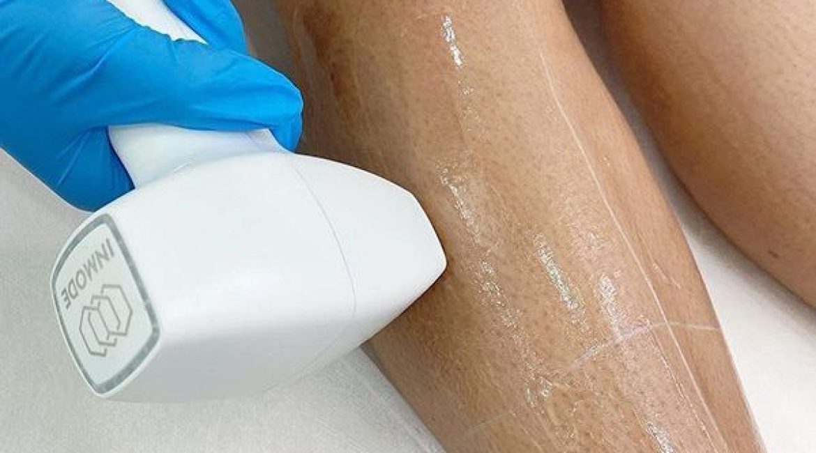 Different Laser Hair Removal Technologies