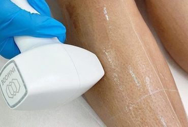 Different Laser Hair Removal Technologies
