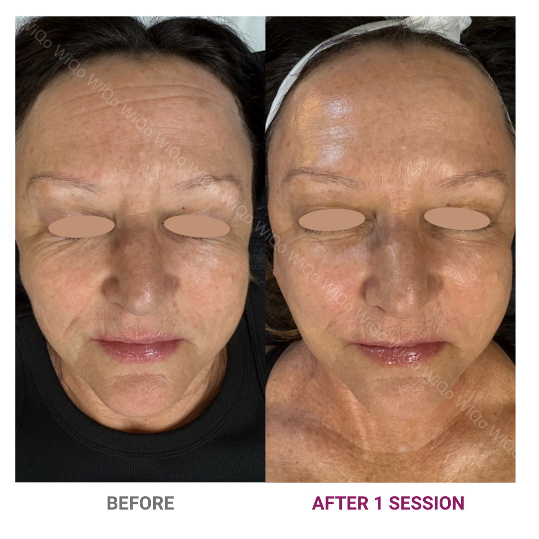 PRX-Plus before and after result 5