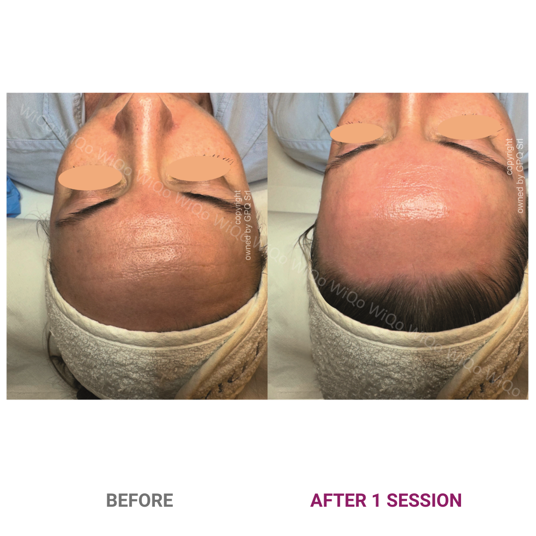 PRX-Plus before and after result 4