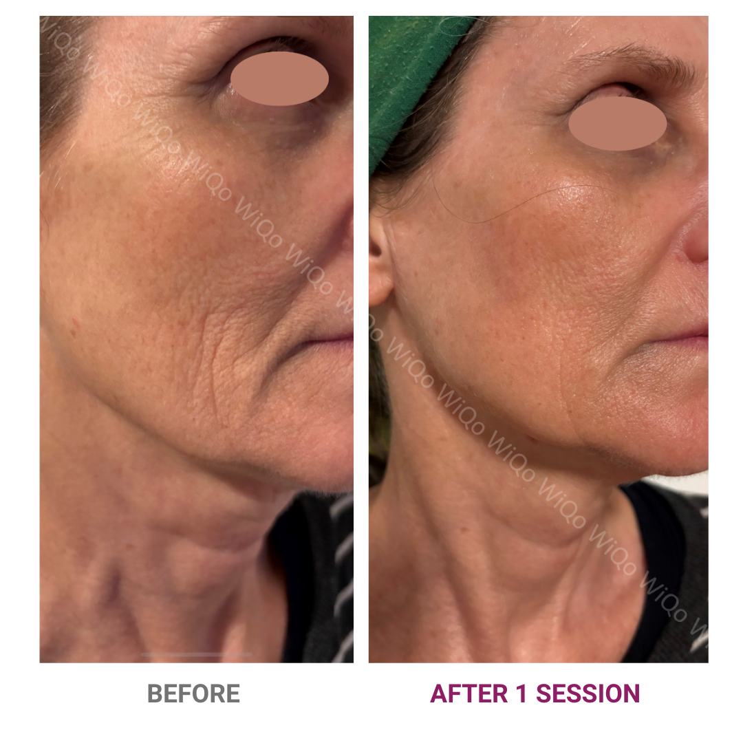 PRX-Plus before and after result 3