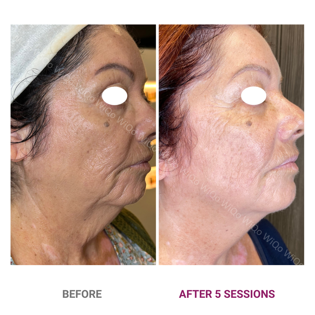 PRX-Plus before and after