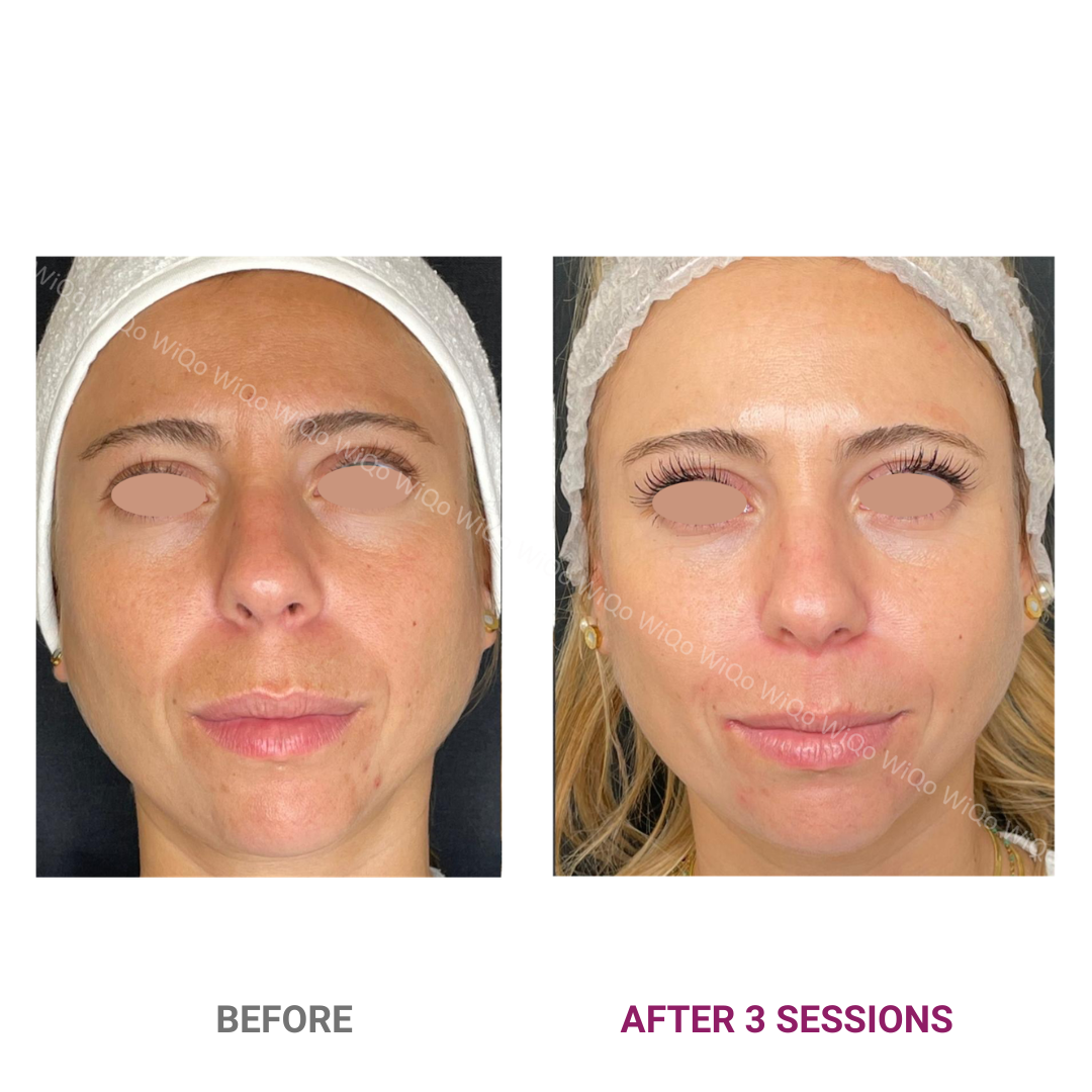 PRX-Plus before and after