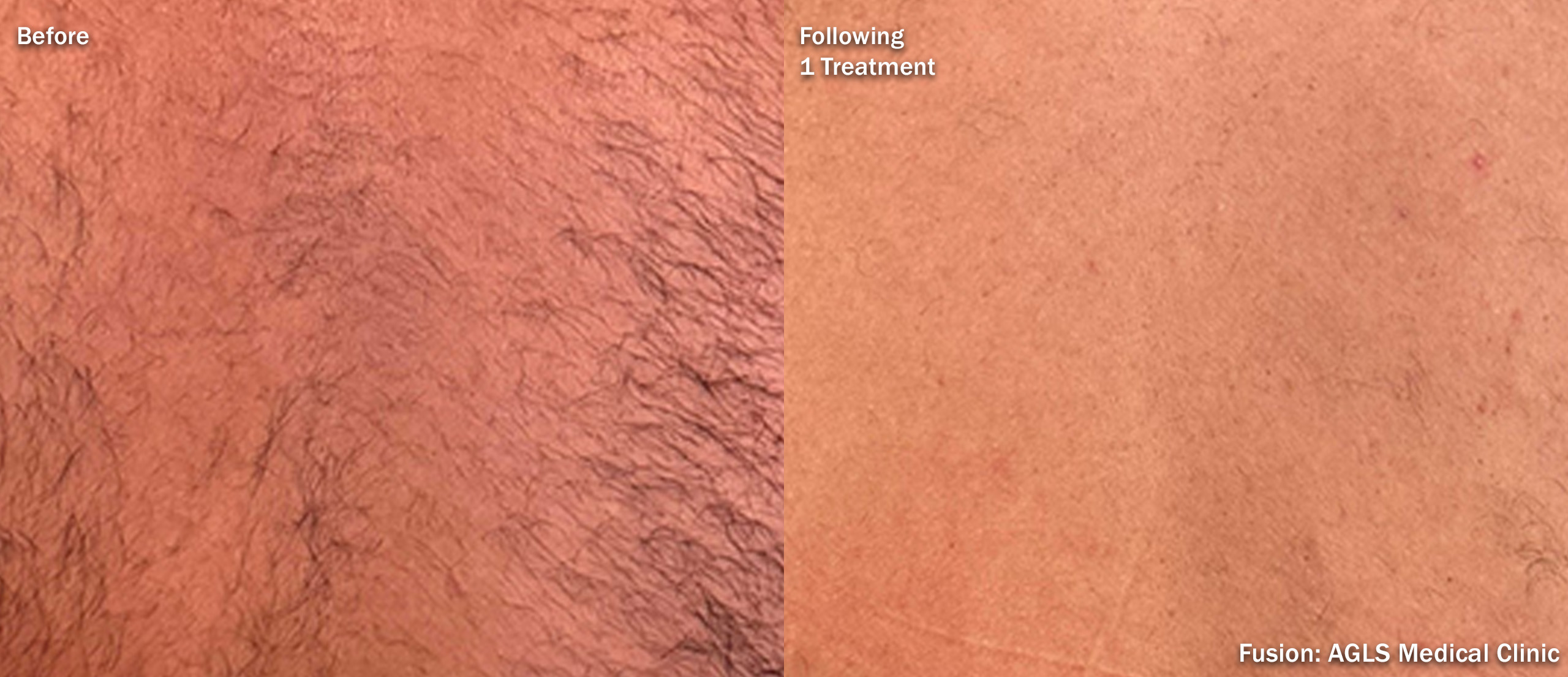 Diolaze XL before and after — back