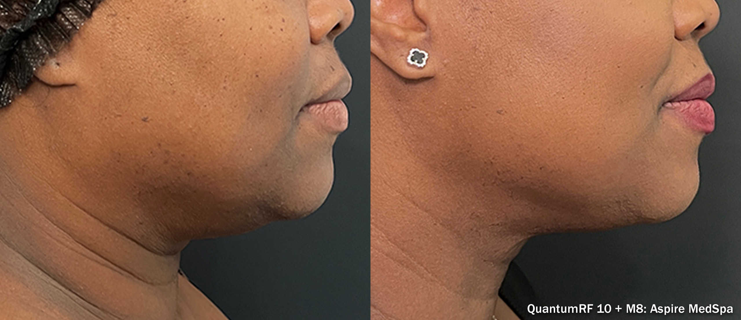 Quantum RF 10 before and after — Aspire MedSpa