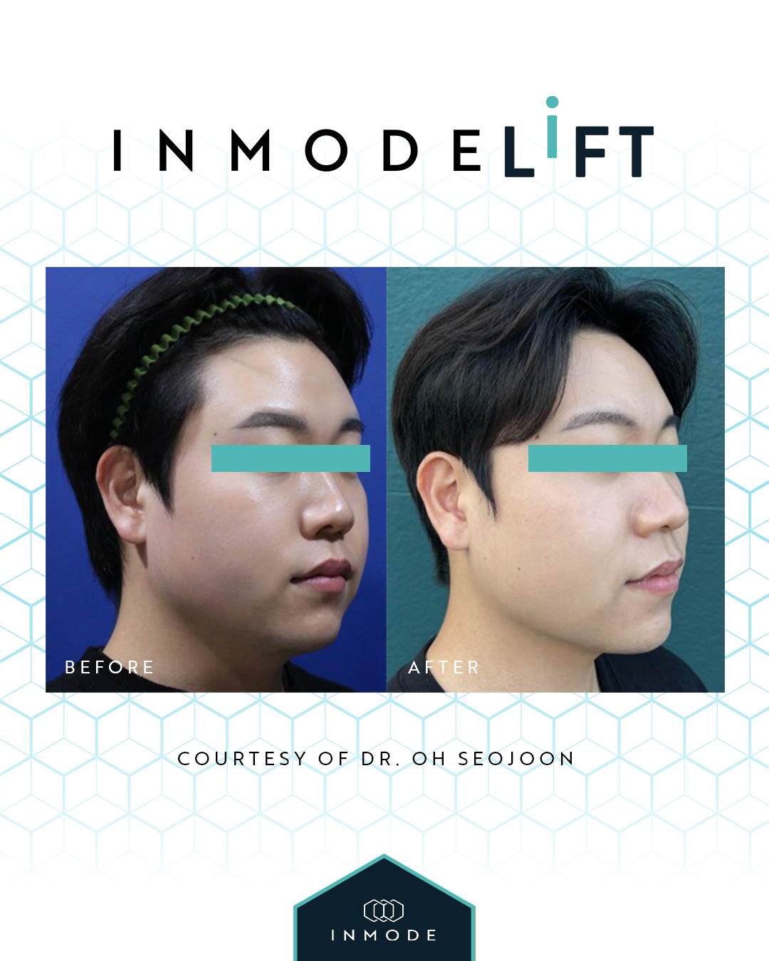 MiniFX before and after result 3