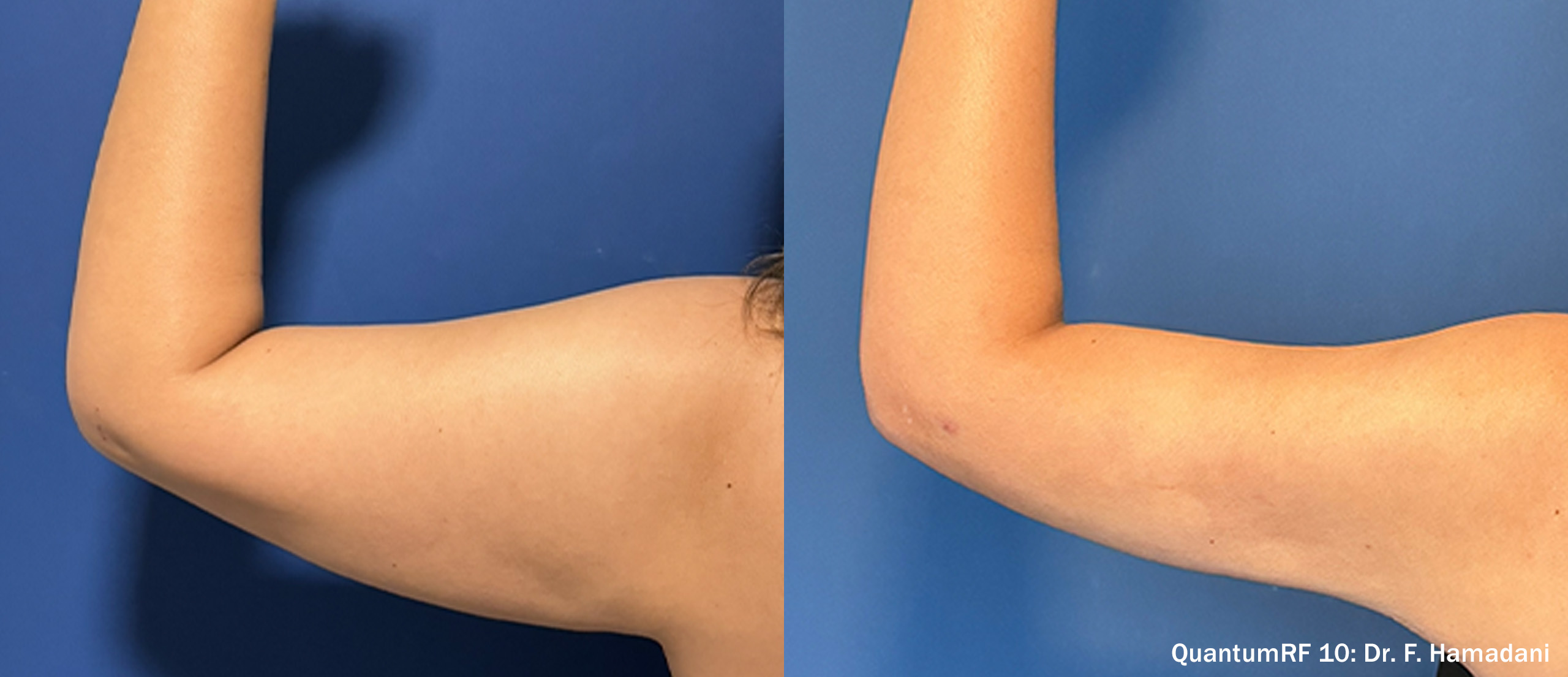 Quantum RF 10 before and after — arms female