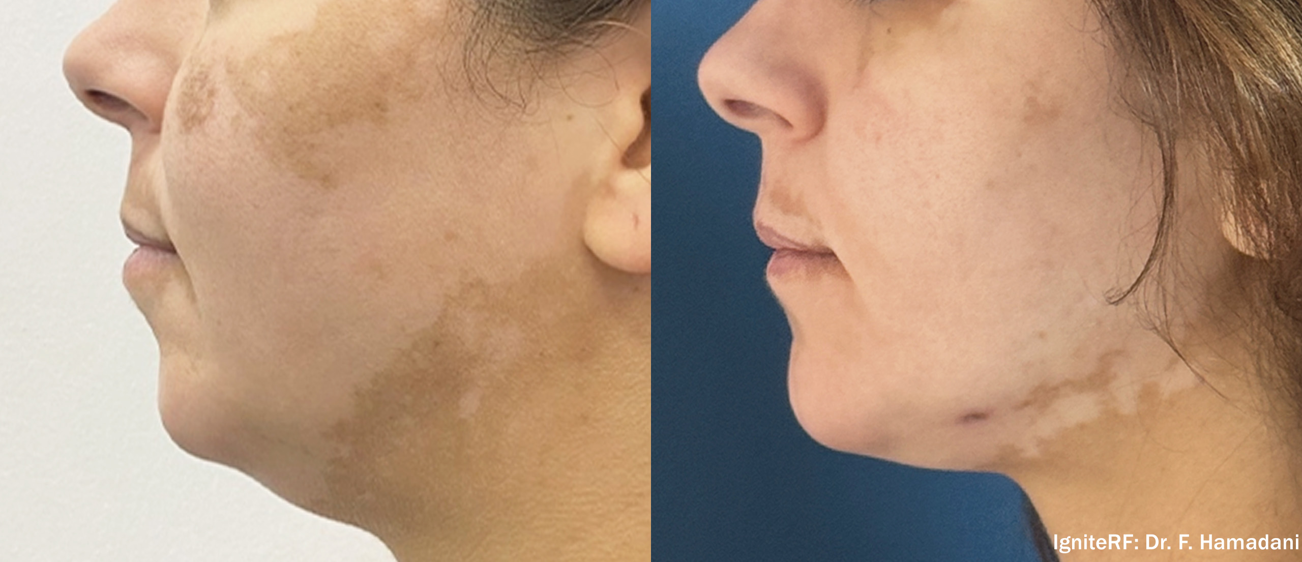 Quantum RF 10 before and after — jowl female left side