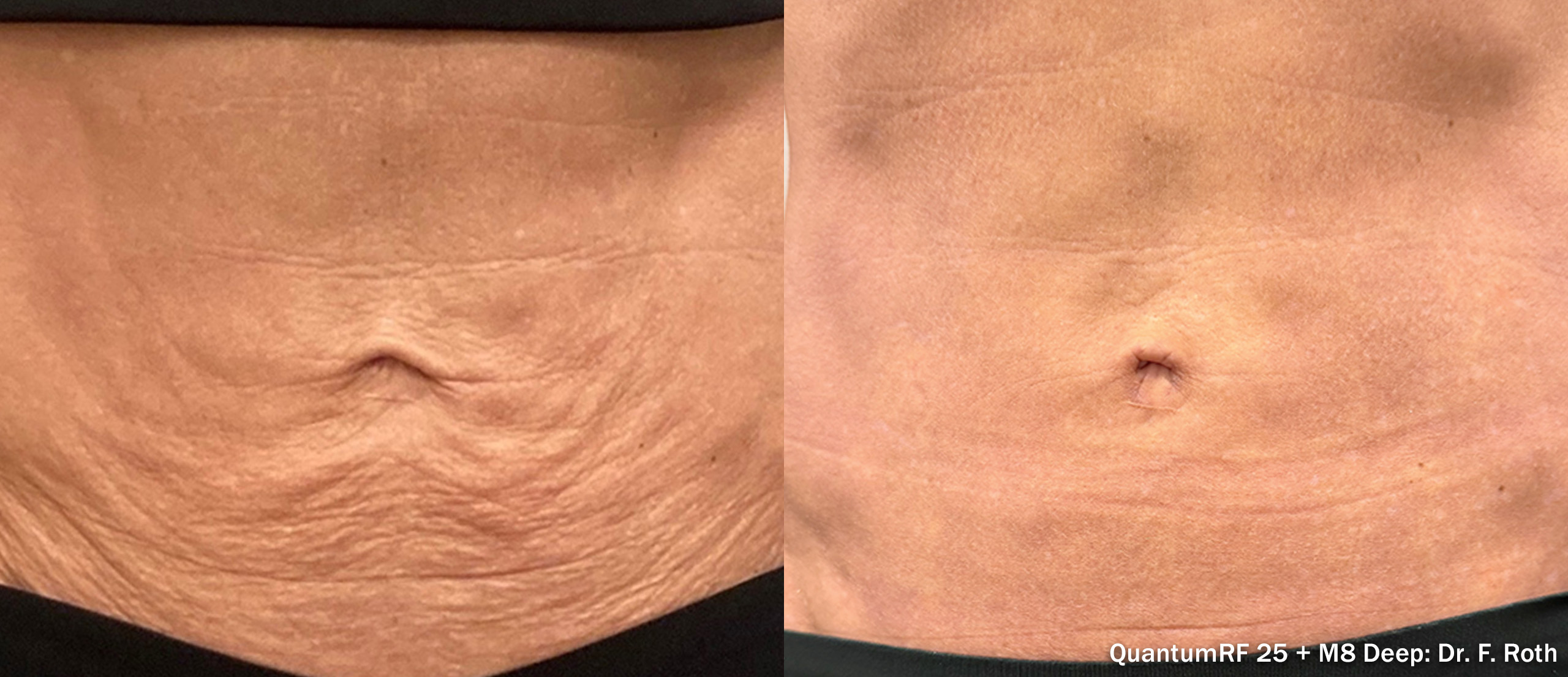 Quantum RF 25 before and after — abdomen front