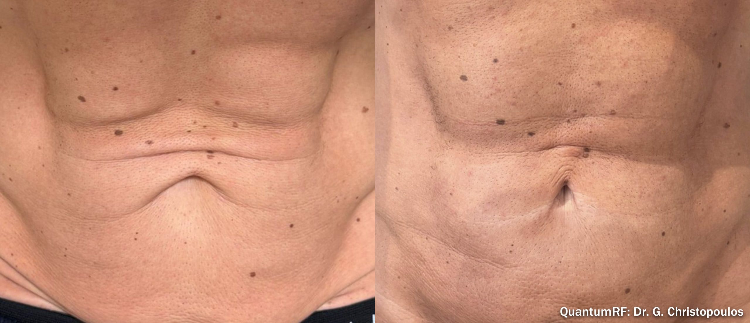 Quantum RF 25 before and after — male abdomen
