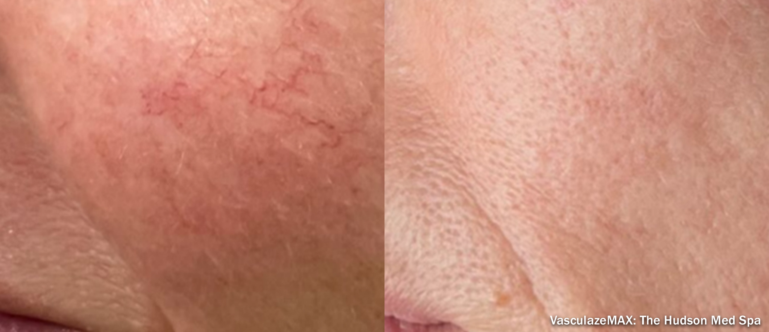 Vasculaze before and after — cheek