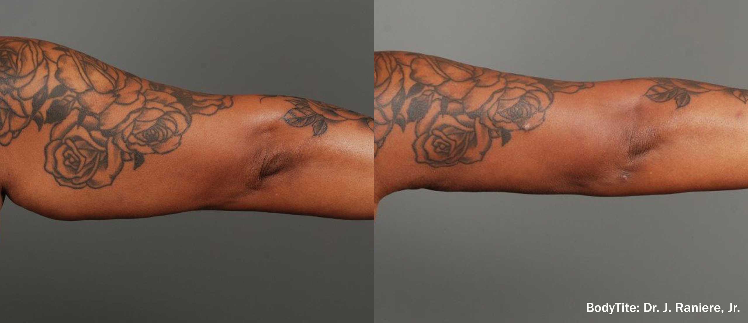 BodyTite before and after — arm result