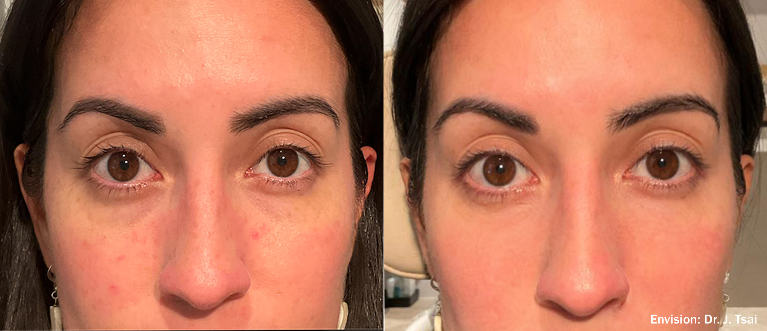 Lumecca before and after — cheeks