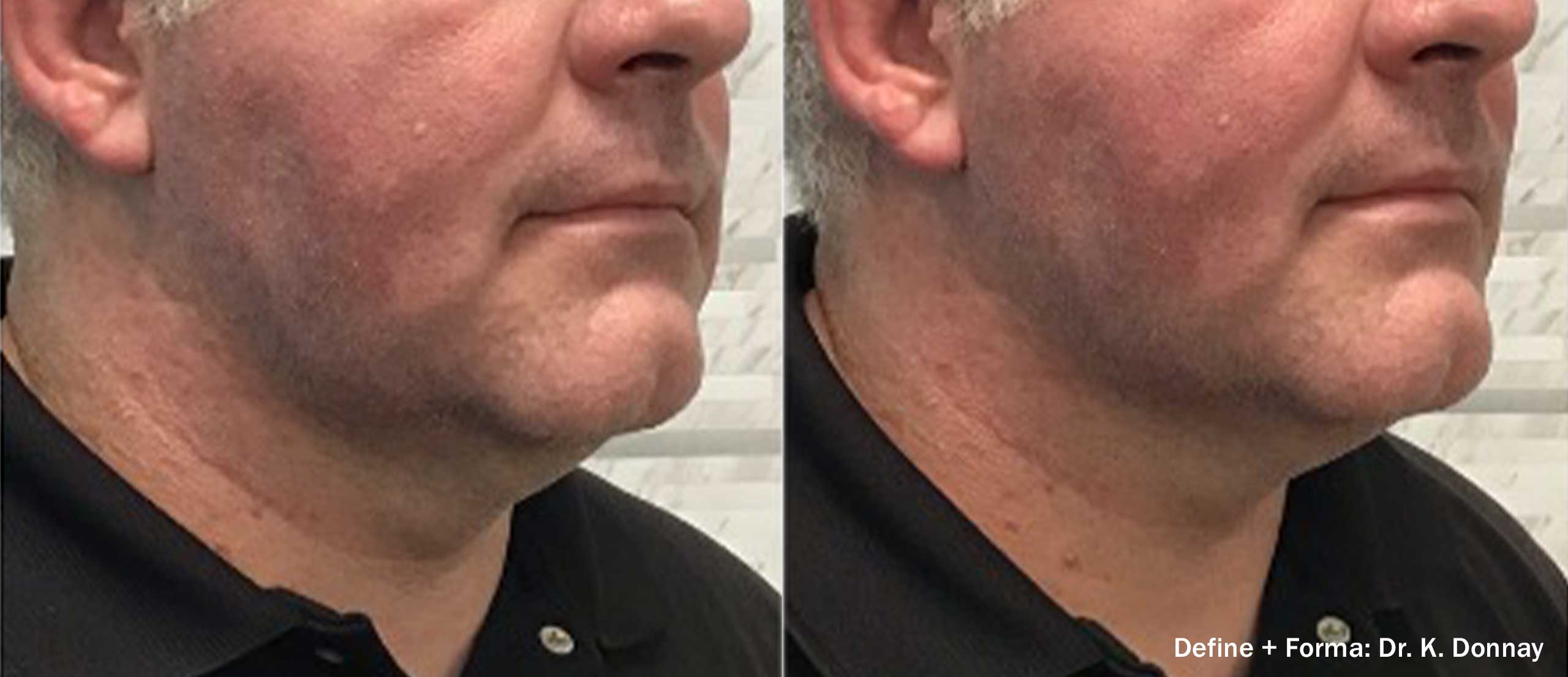 Morpheus8 before and after — 4 weeks right side