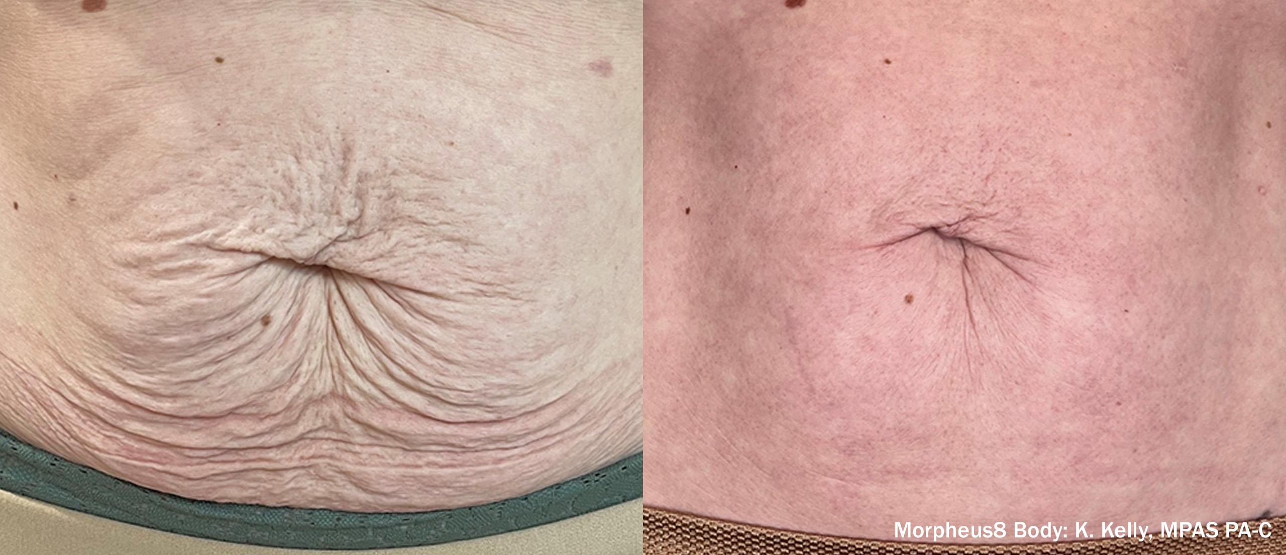 Morpheus8 Body before and after — abdomen 24 weeks