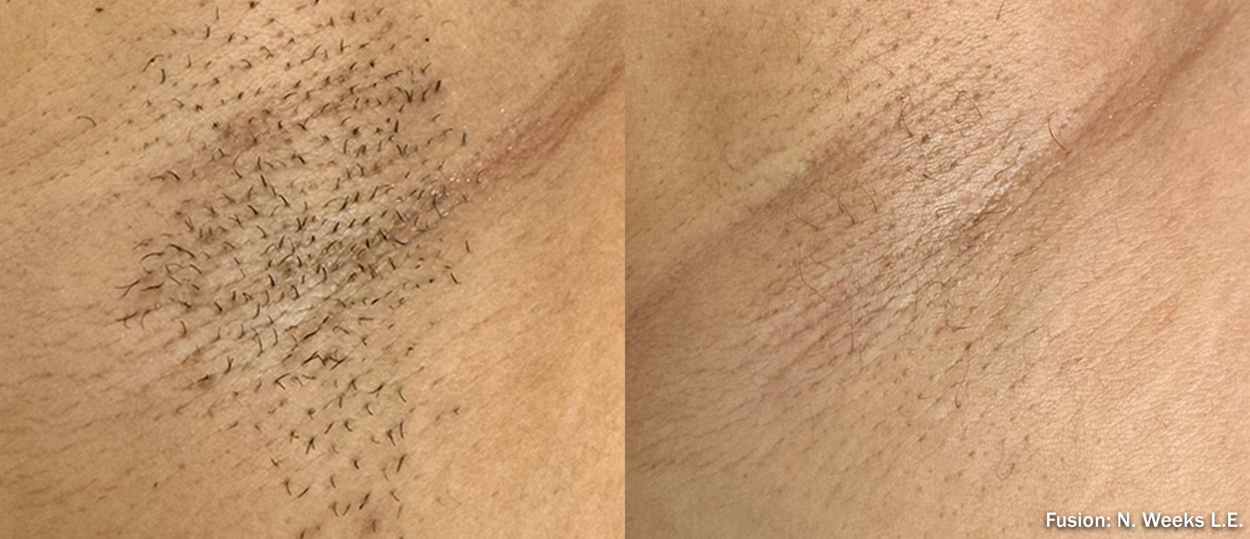 Diolaze XL before and after — underarm