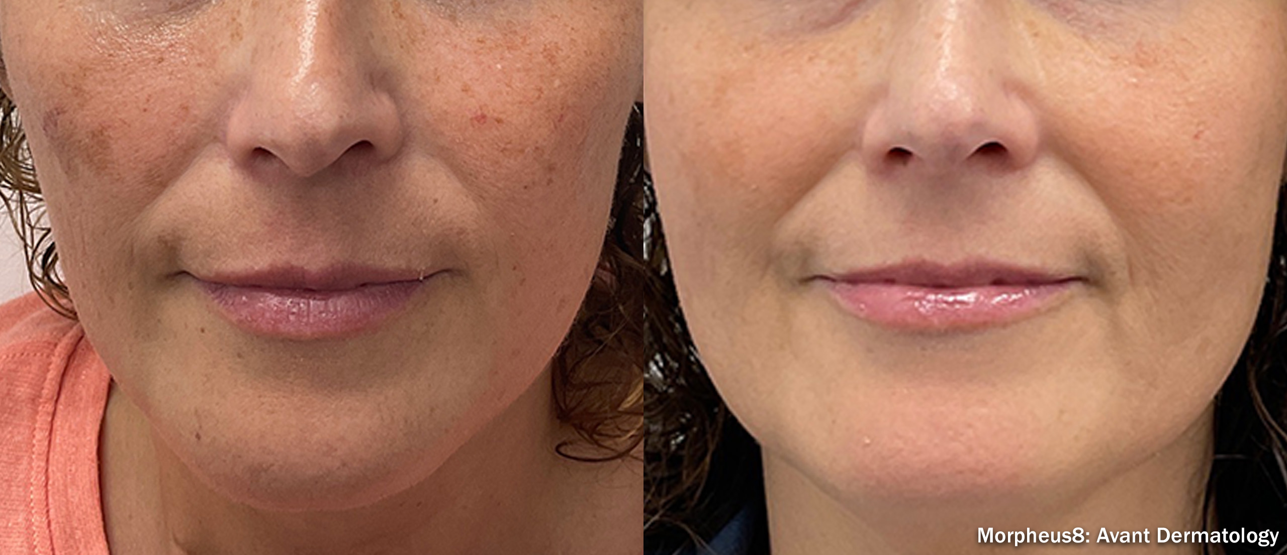 Morpheus8 Burst before and after — female face