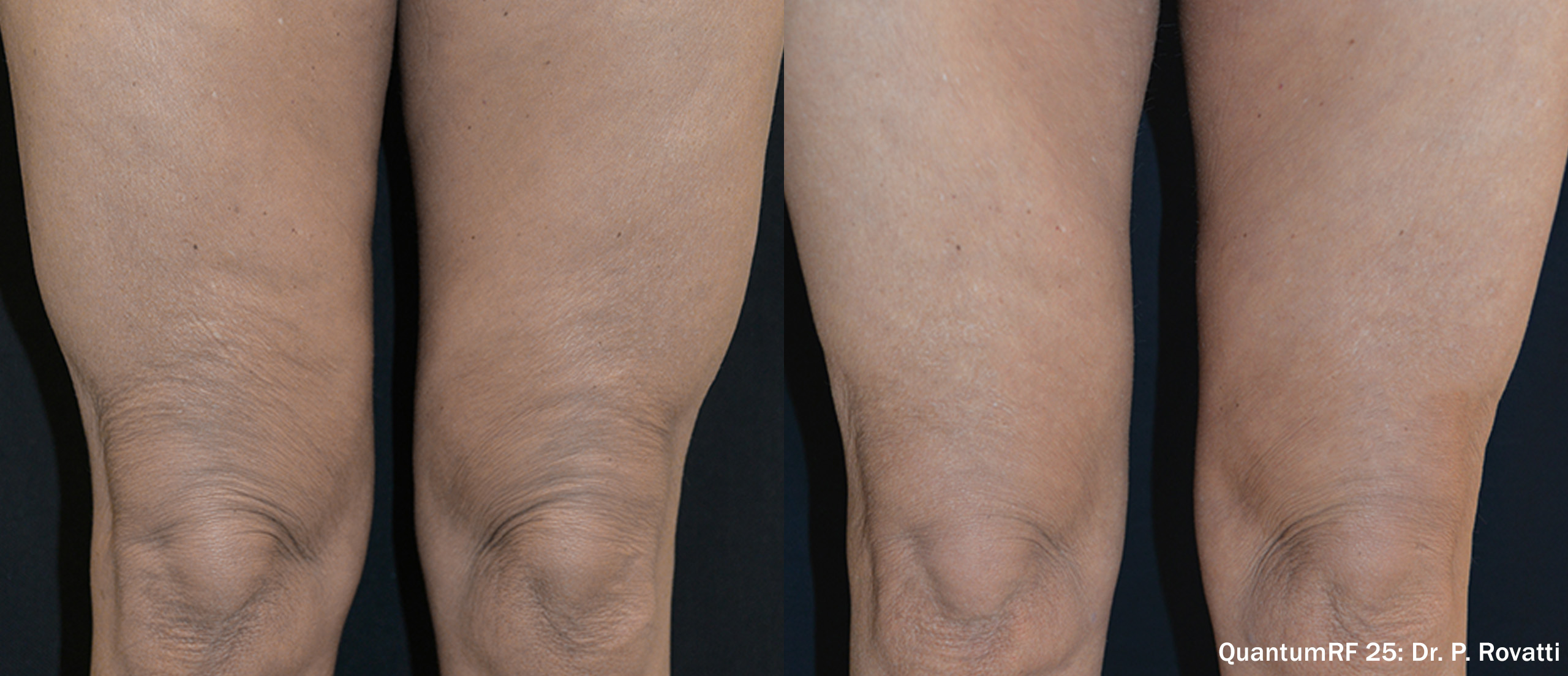 Quantum RF 25 before and after — thighs female front