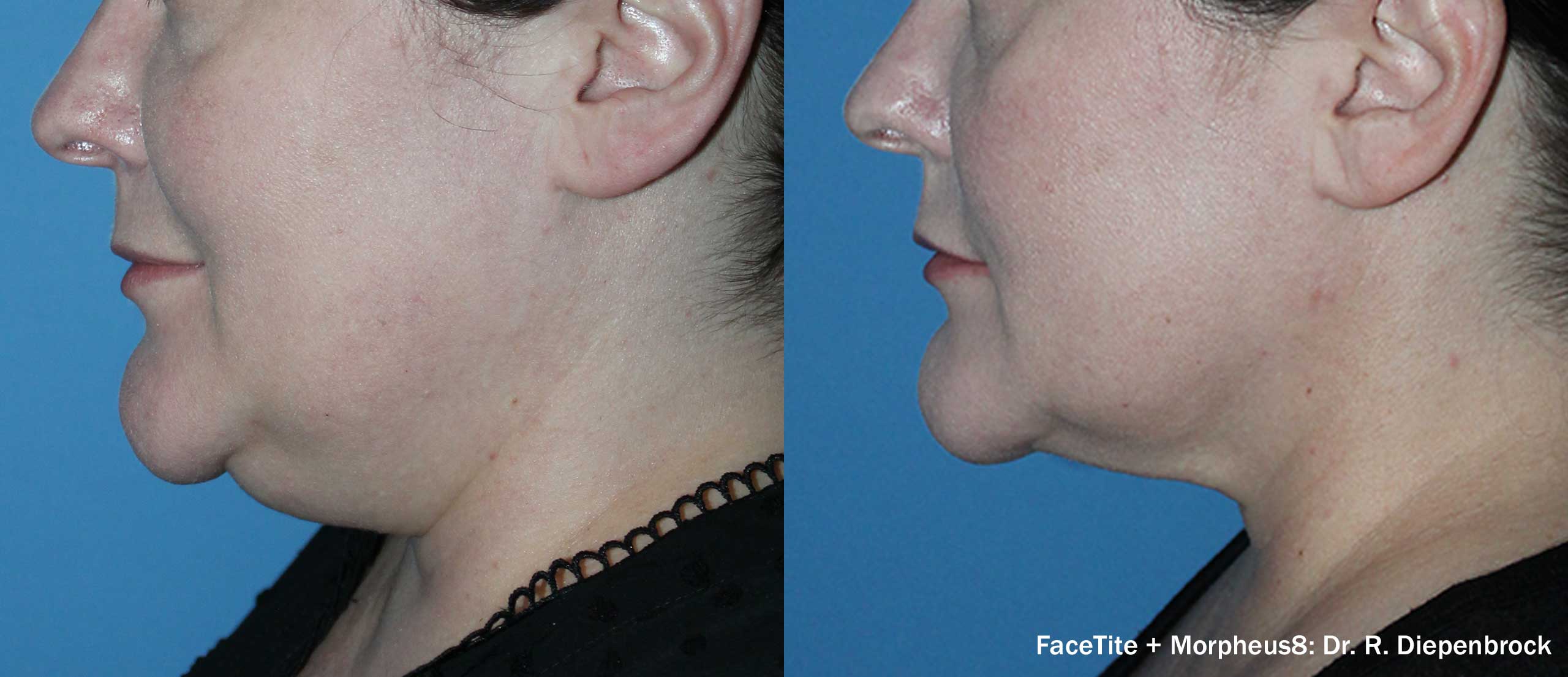 Morpheus8 Burst before and after — 2 years left side