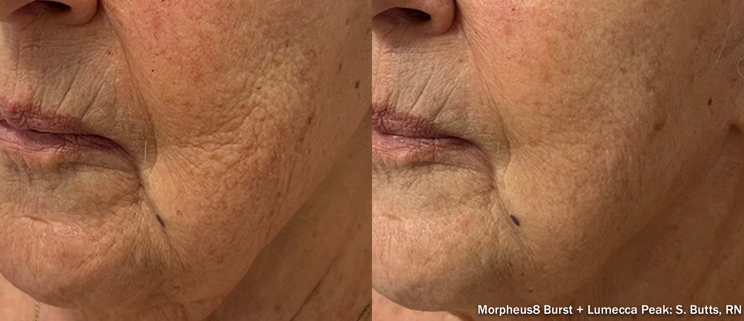 Morpheus8 Burst before and after — face angled