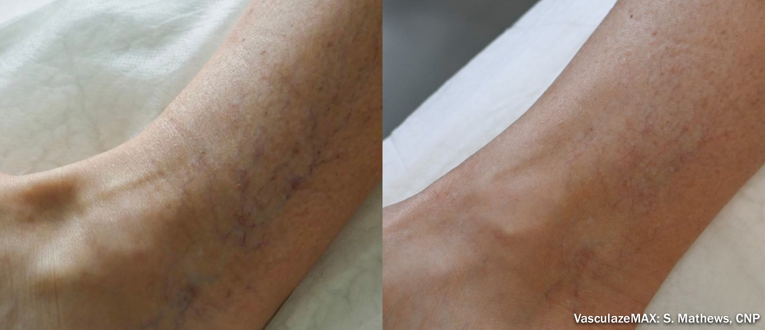 Vasculaze before and after — leg veins