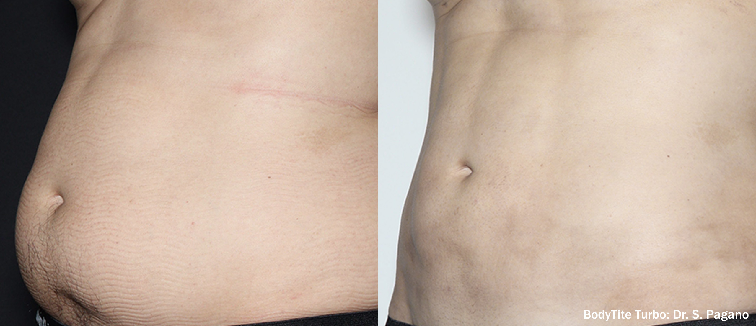 BodyLight RF Turbo before and after — abdomen male