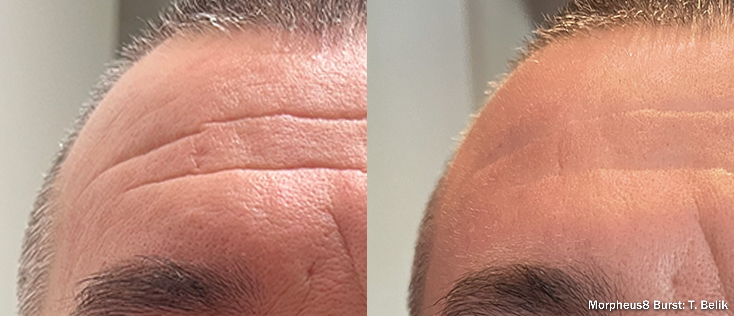 Morpheus8 Burst before and after — face
