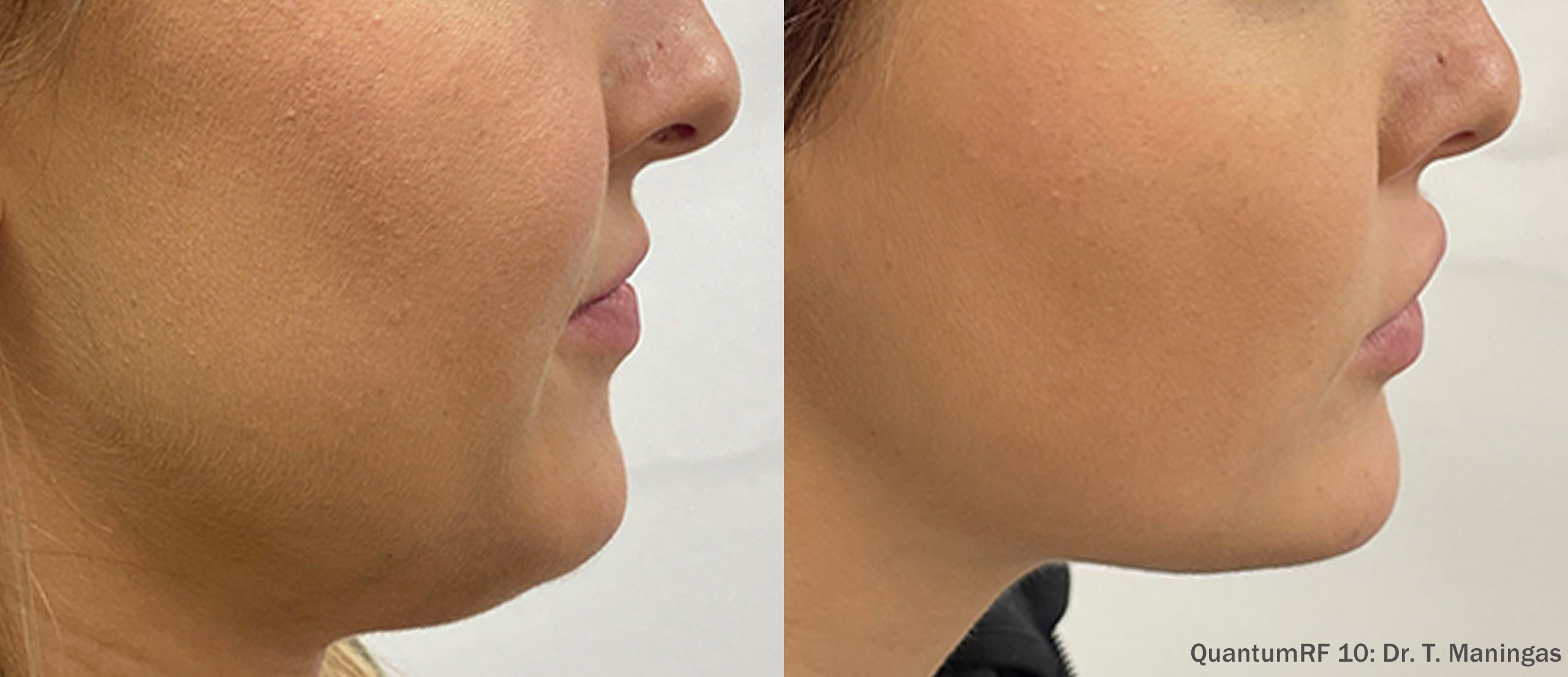 Quantum RF 10 before and after — face right side