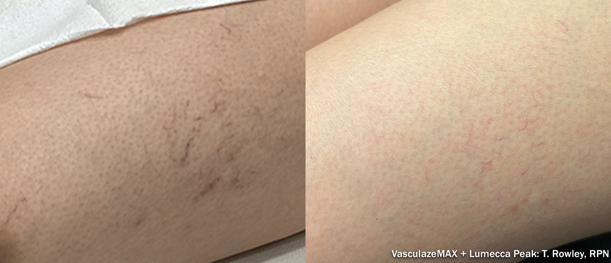 Vasculaze before and after — leg veins combination