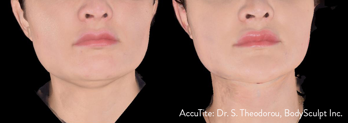 AccuTite before and after — Dr S. Theodorou