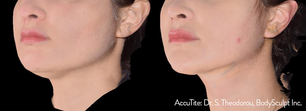 AccuTite before and after — Dr S. Theodorou 2