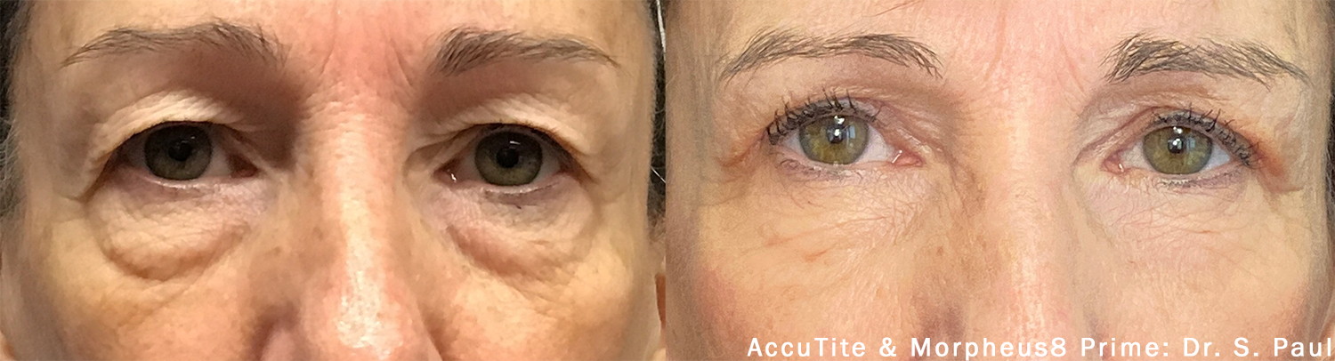 AccuTite before and after — Dr S. Paul