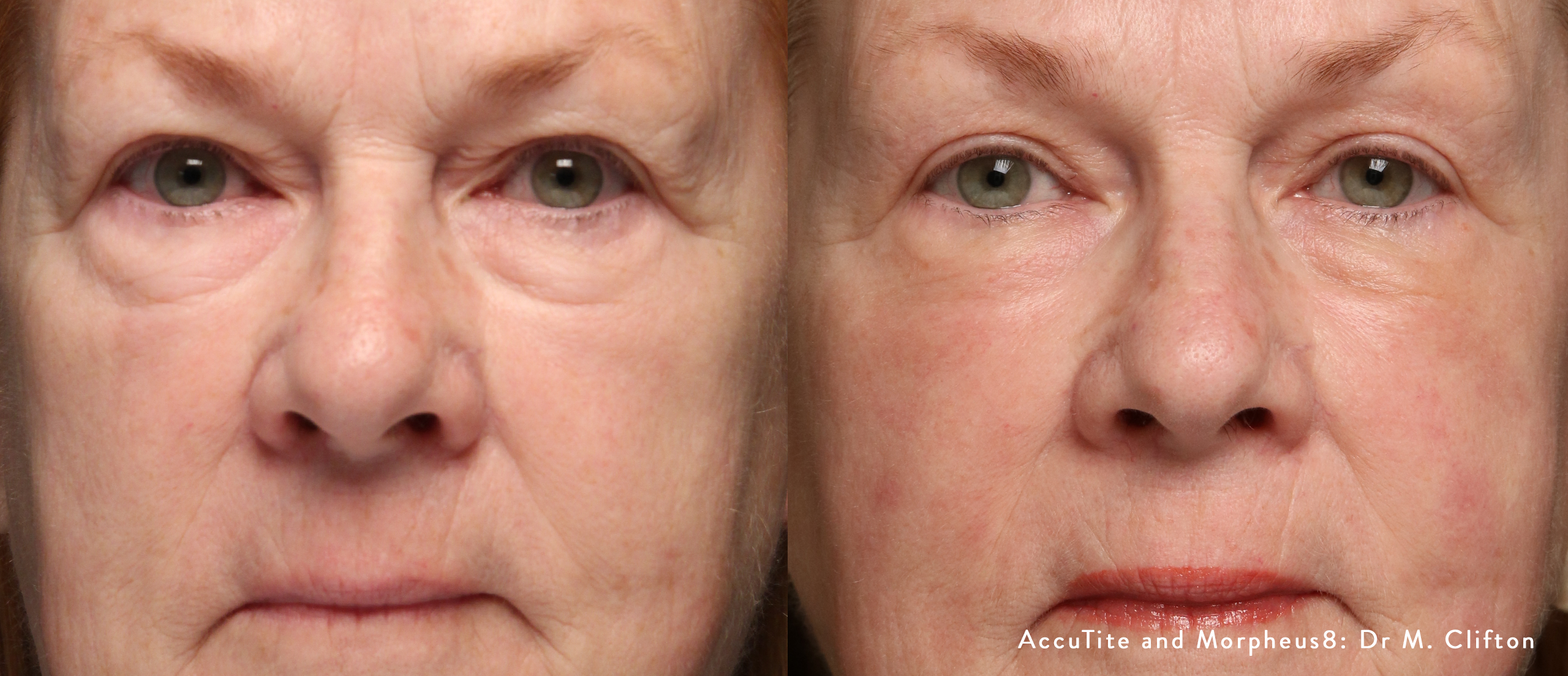 AccuTite before and after — Dr M. Clifton