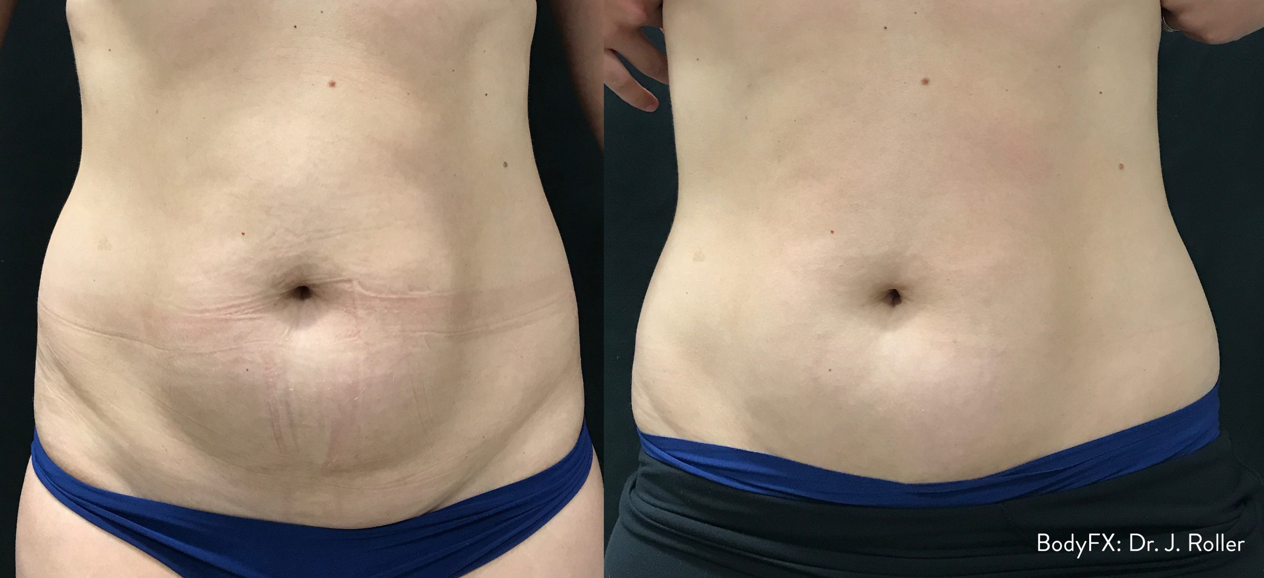MiniFX before and after — Dr J. Roller