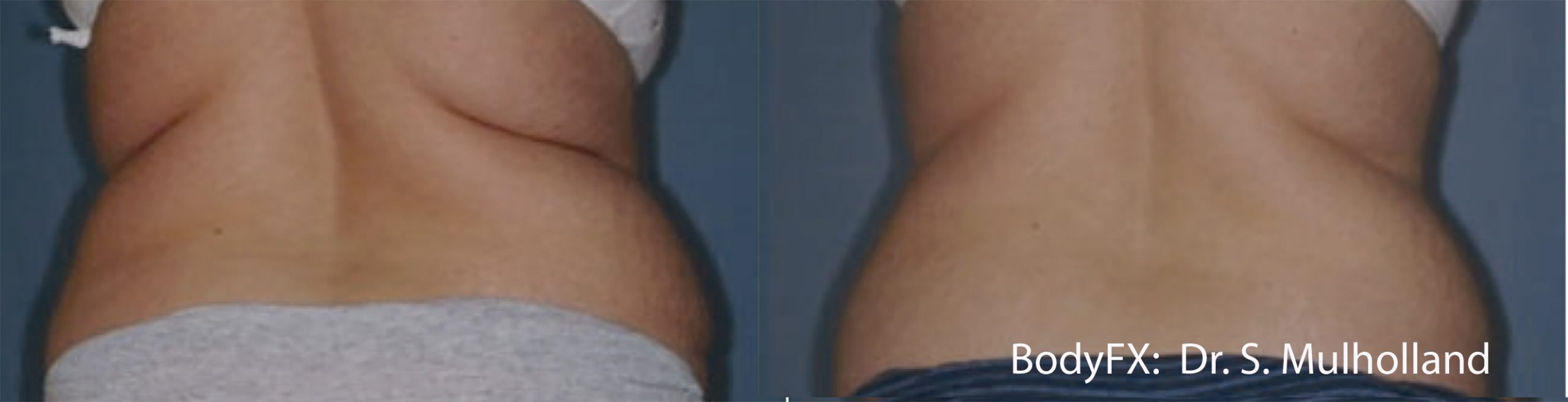 MiniFX before and after — Dr S. Mulholland