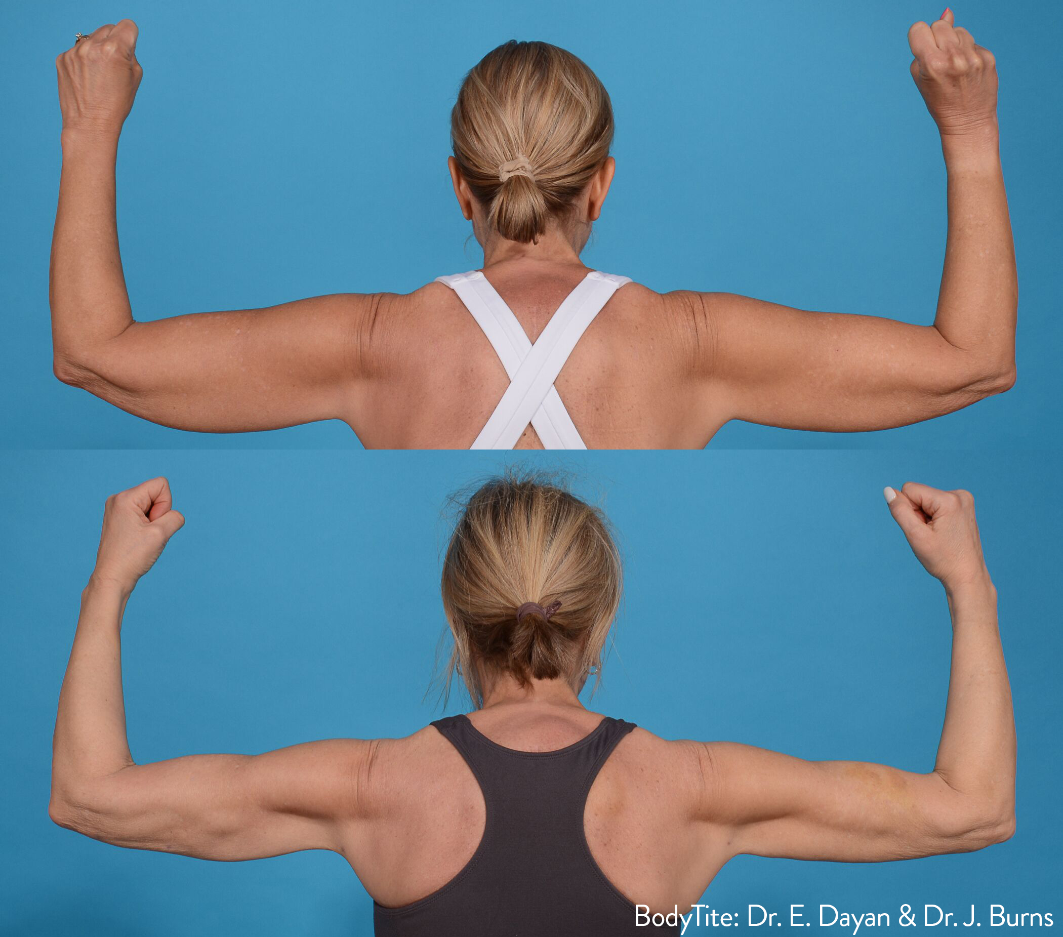 BodyTite before and after — Dr E. Dayan & Dr J. Burns