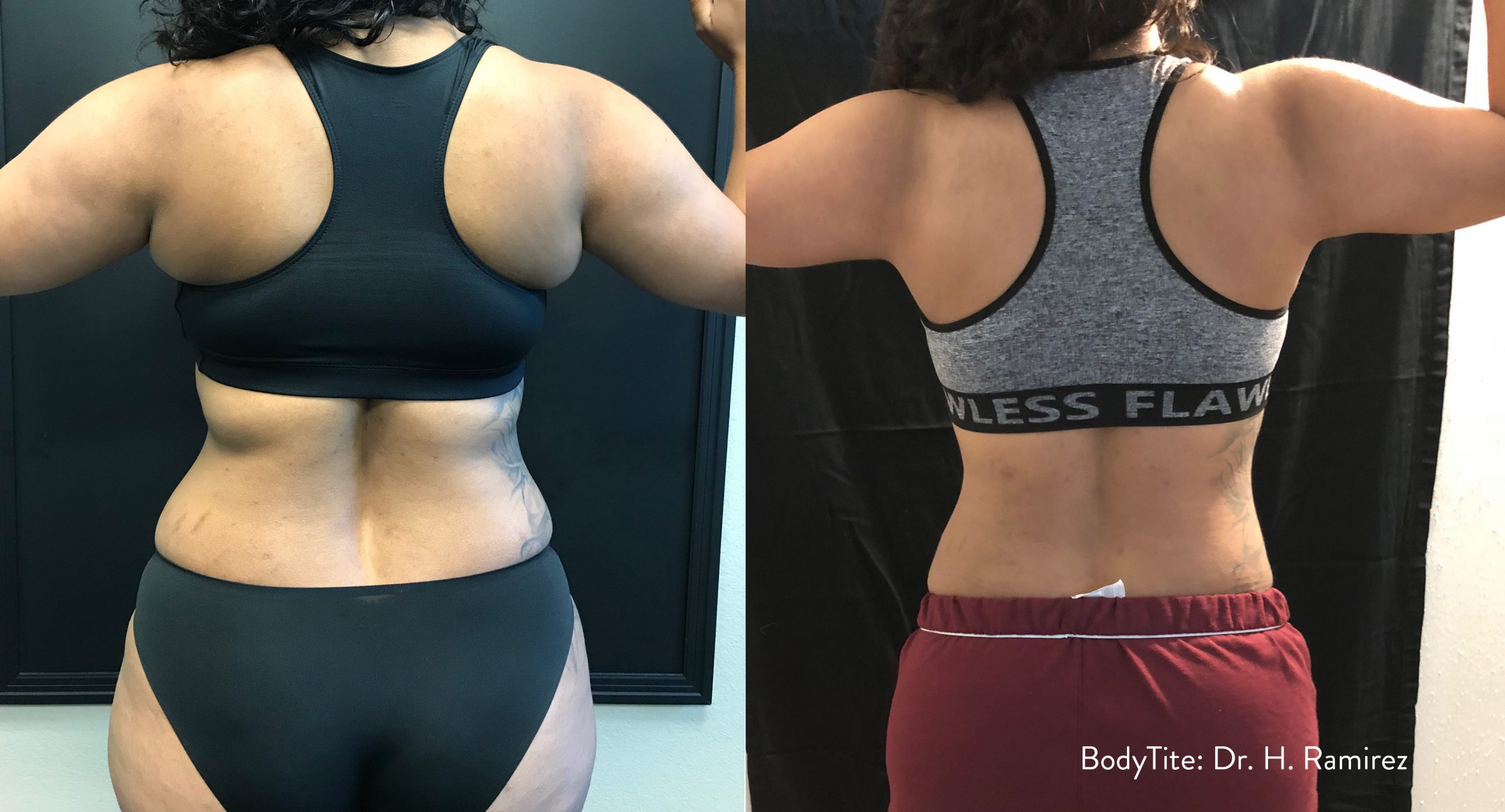 BodyTite before and after — Dr H. Ramirez