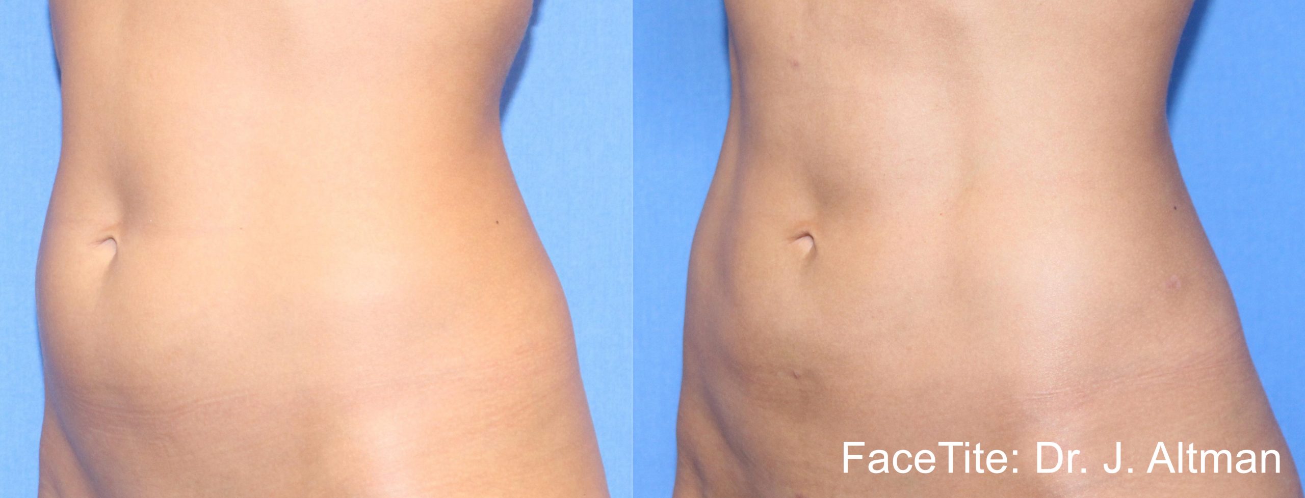 BodyTite before and after — Dr J. Altman