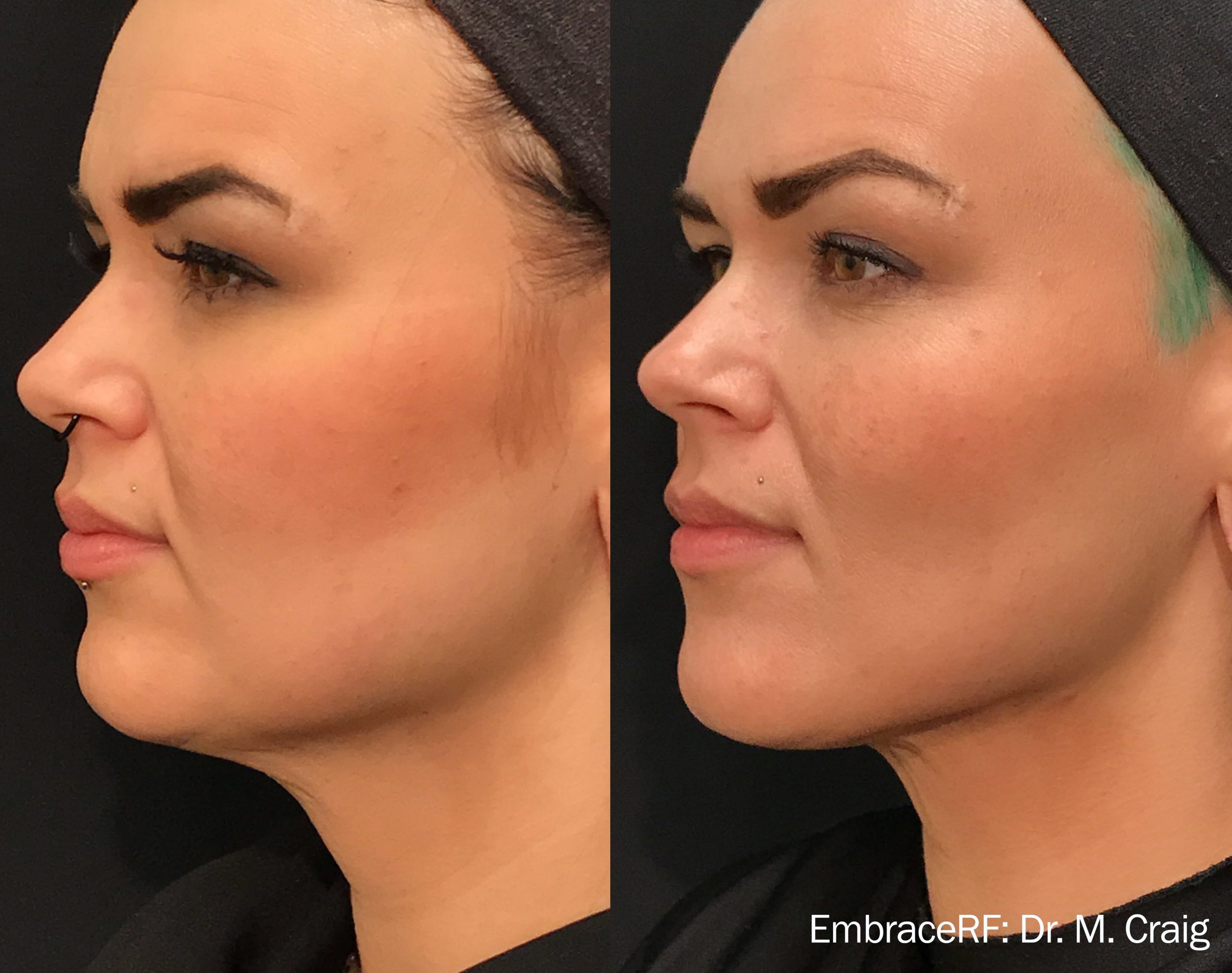 Morpheus8 before and after — Dr M. Craig