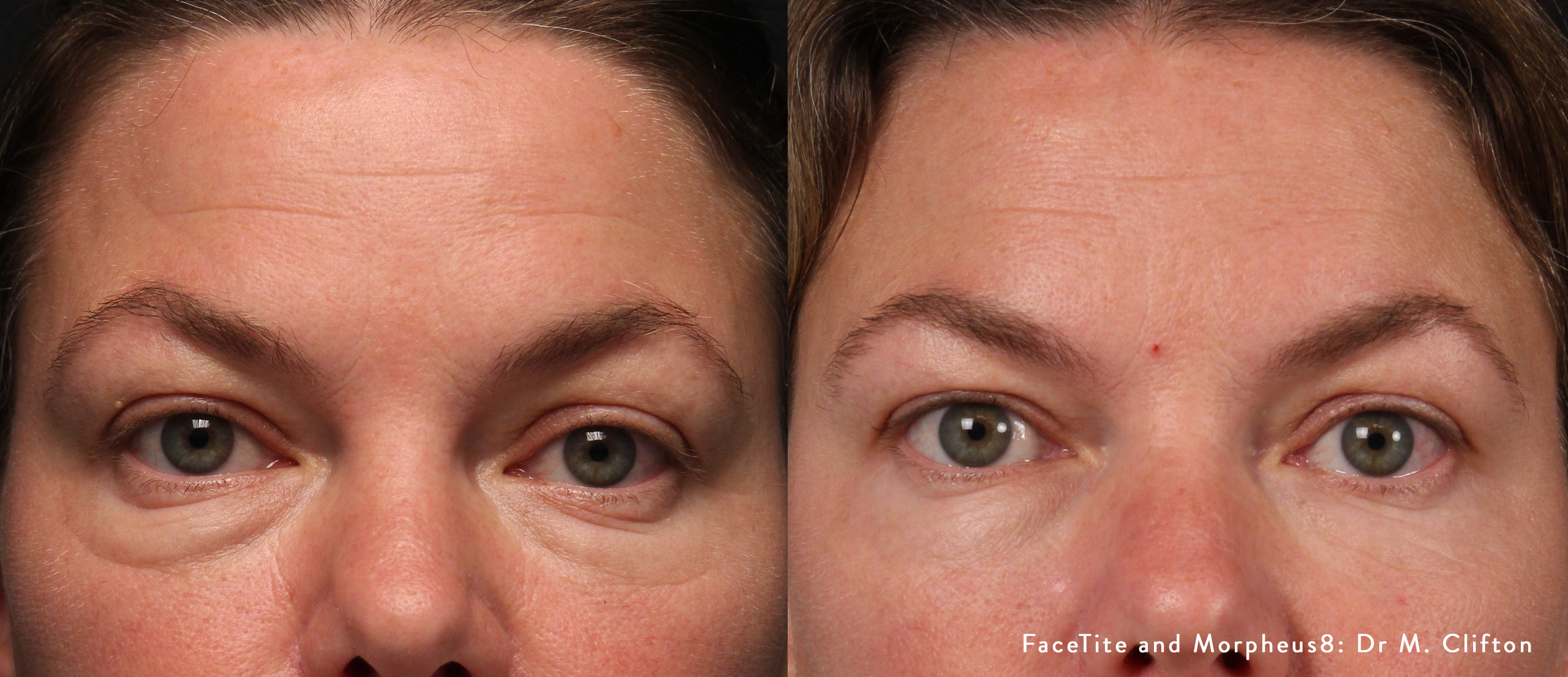 FaceTite and Morpheus8 before and after — Dr M. Clifton 2