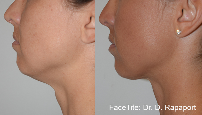 FaceTite before and after — Dr D. Rapaport
