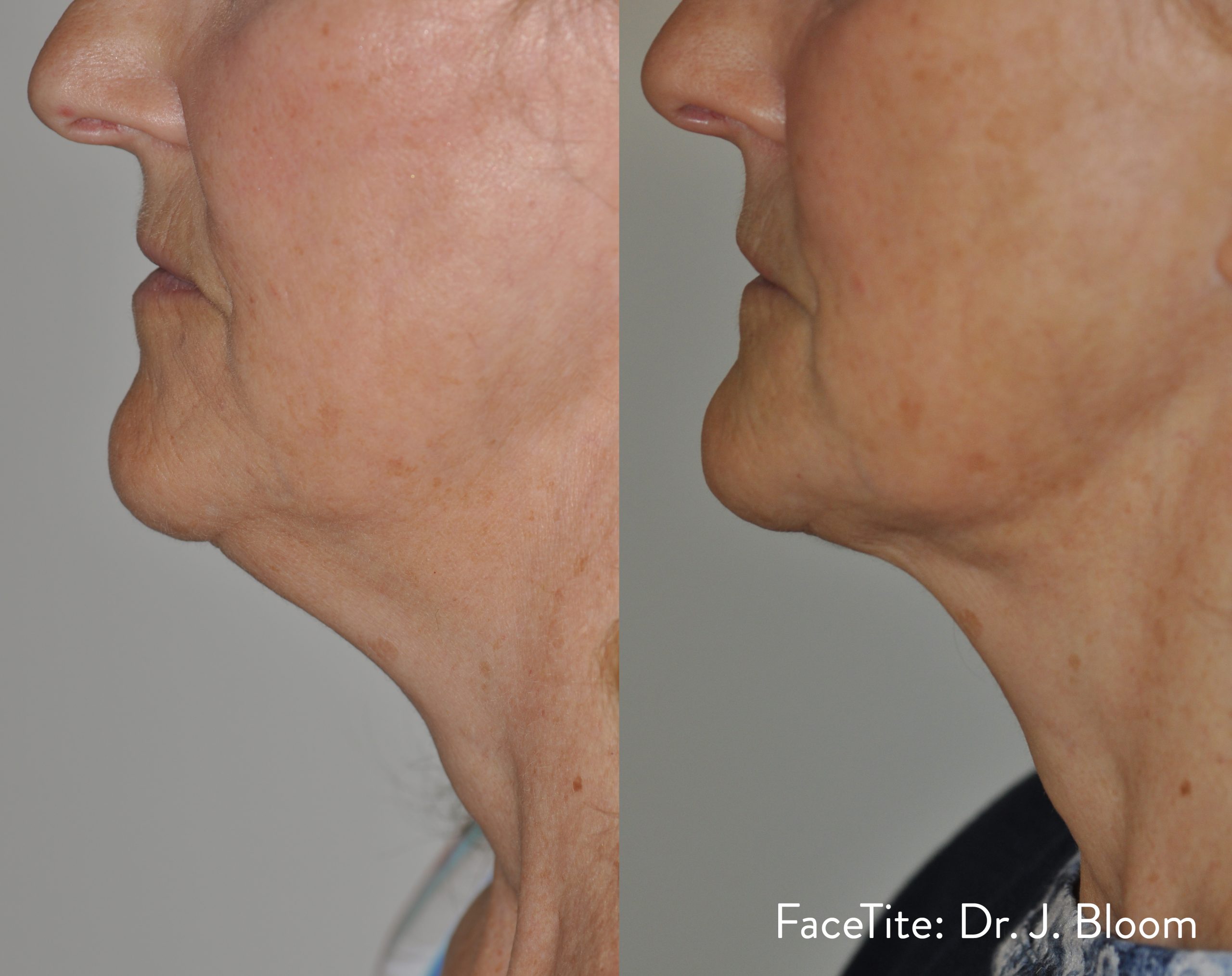 FaceTite before and after — Dr J. Bloom