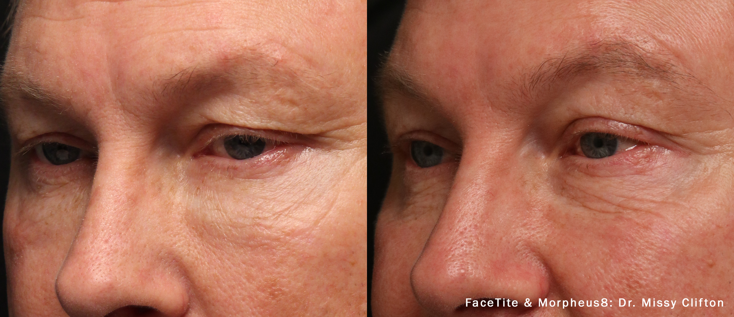 FaceTite and Morpheus8 before and after — Dr M. Clifton