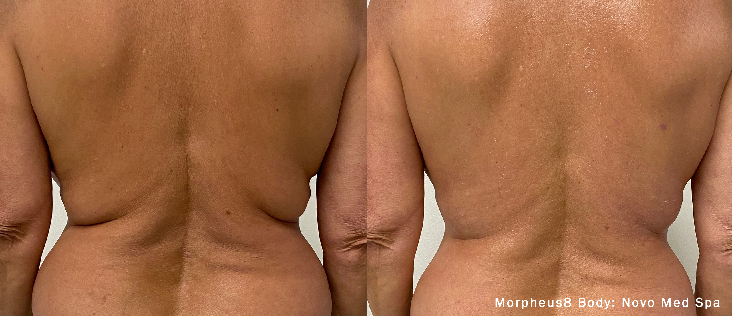 Morpheus8 Body before and after — Novo MedSpa