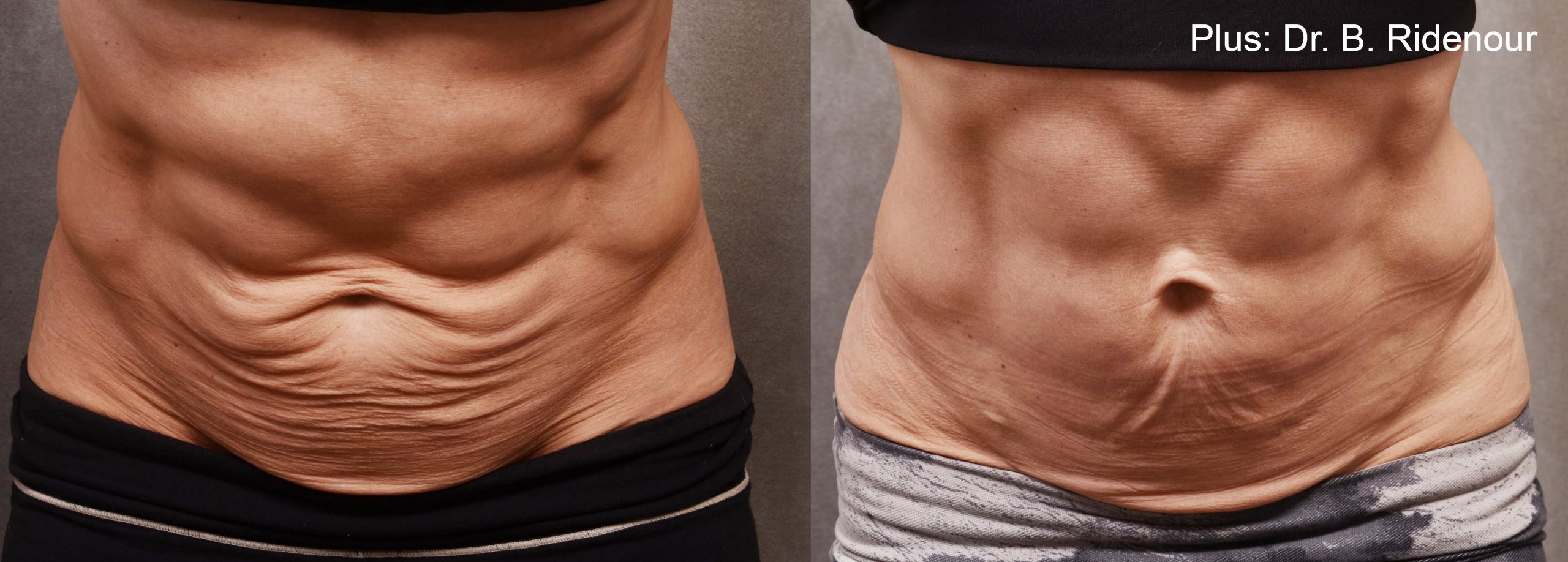 Forma Plus before and after — Dr D. Duncan