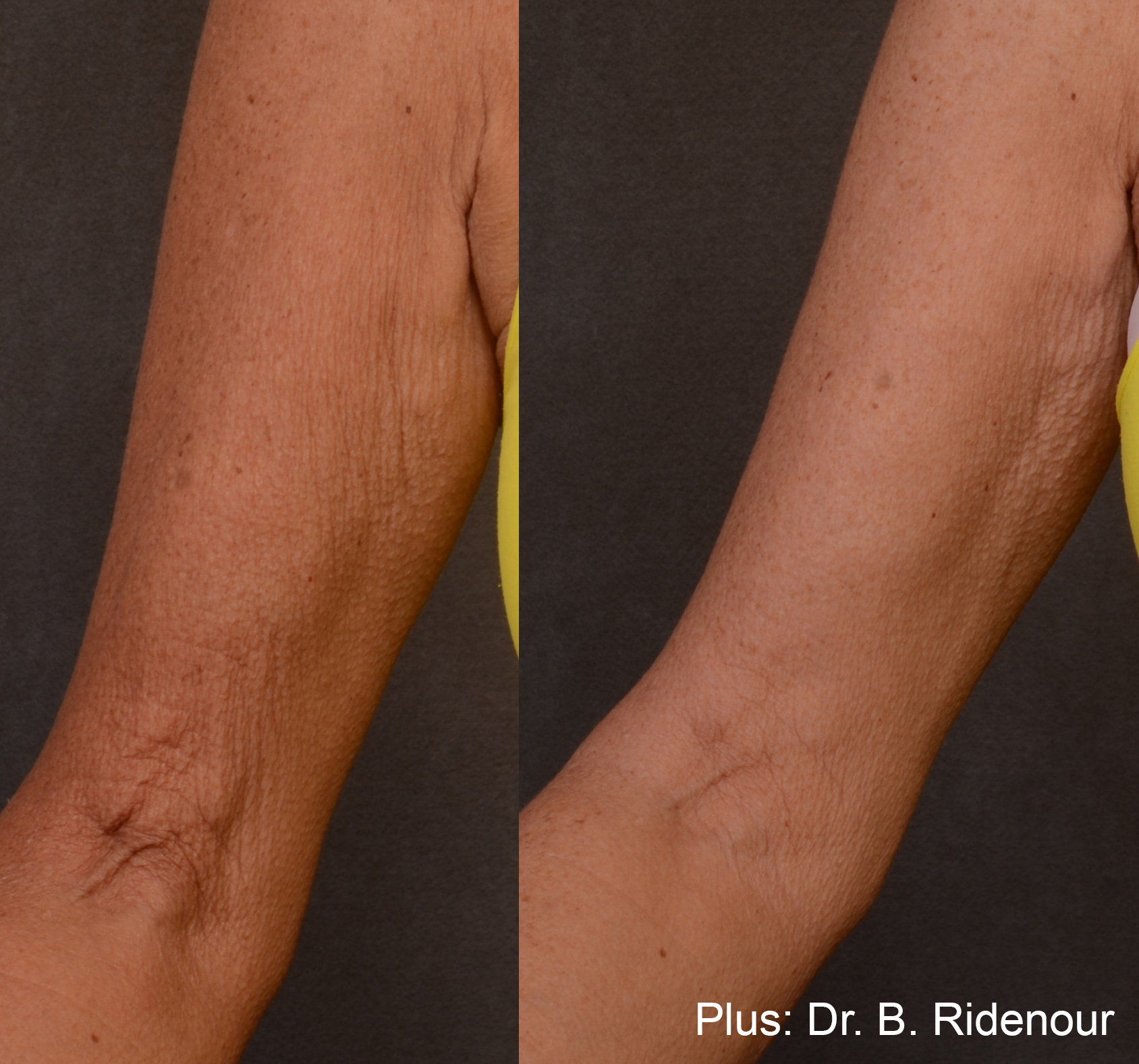 Forma Plus before and after — Dr B. Ridneour