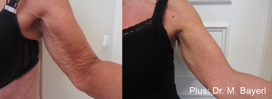 Forma Plus before and after — Dr M. Bayerl