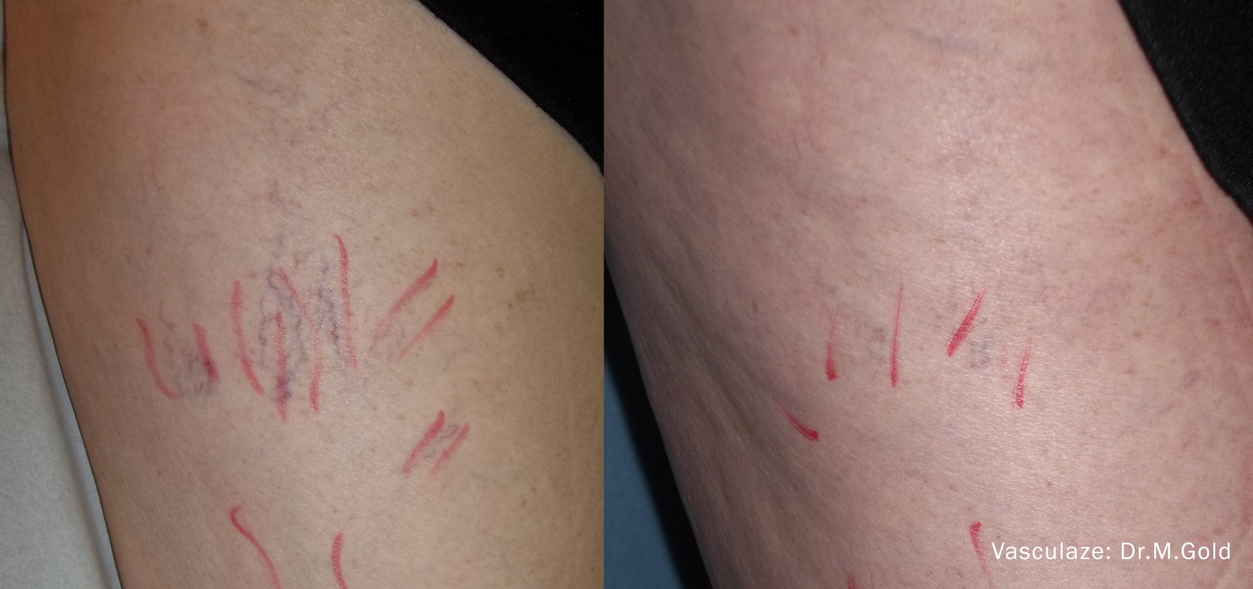 Vasculaze before and after — leg veins
