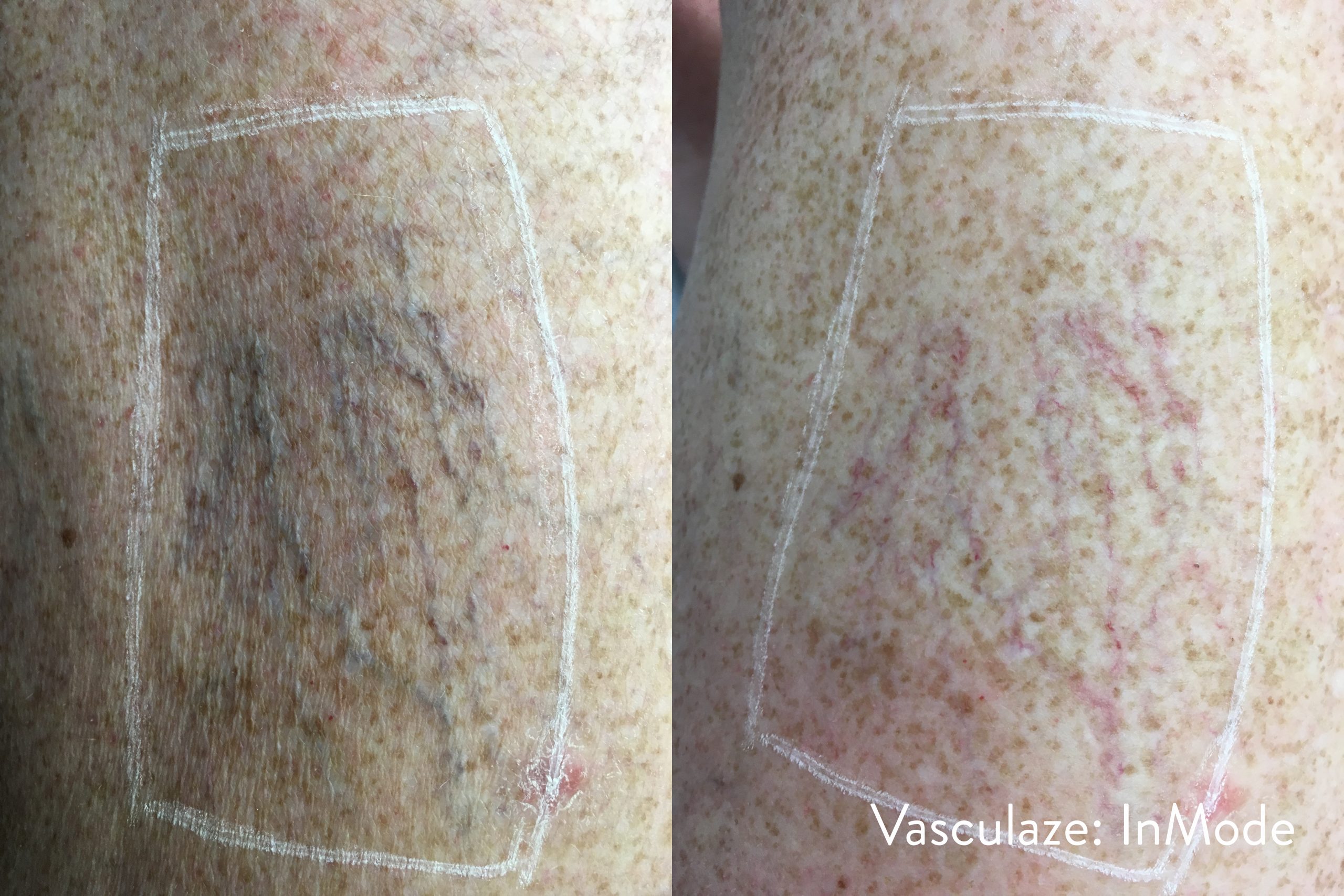 Vasculaze before and after — leg veins combination